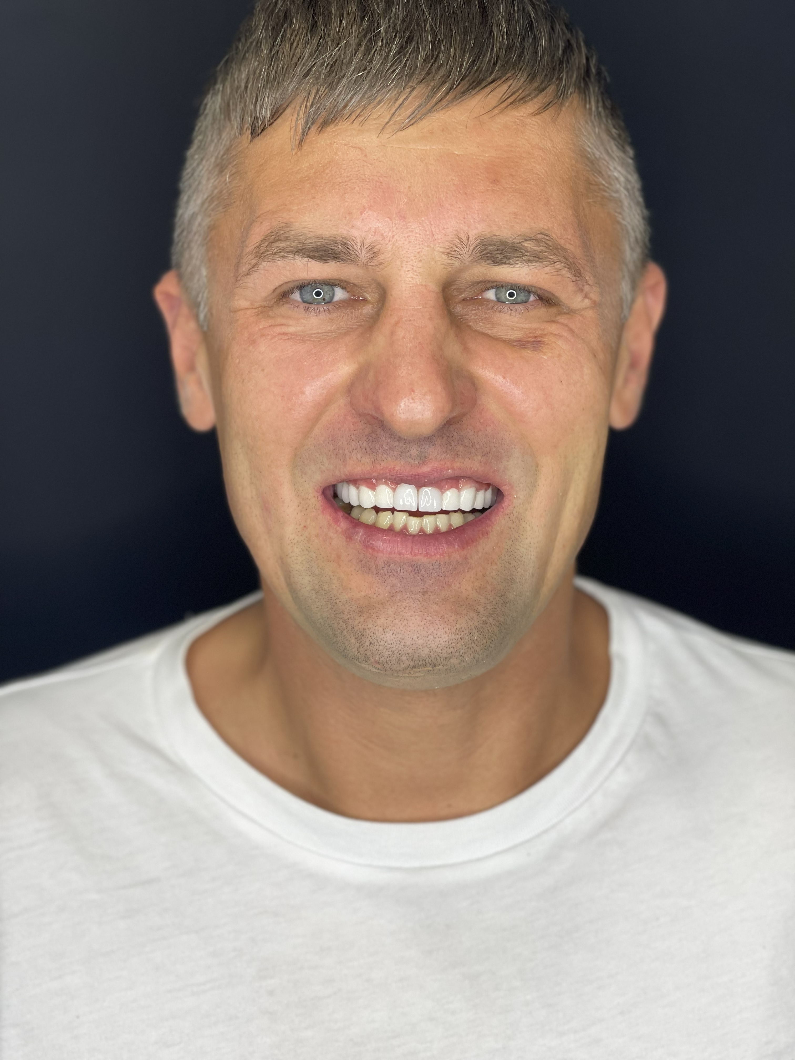 Profesyonel Diş Beyazlatma