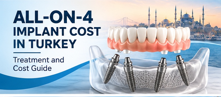 All-on-4 implant cost in Turkey treatment guide