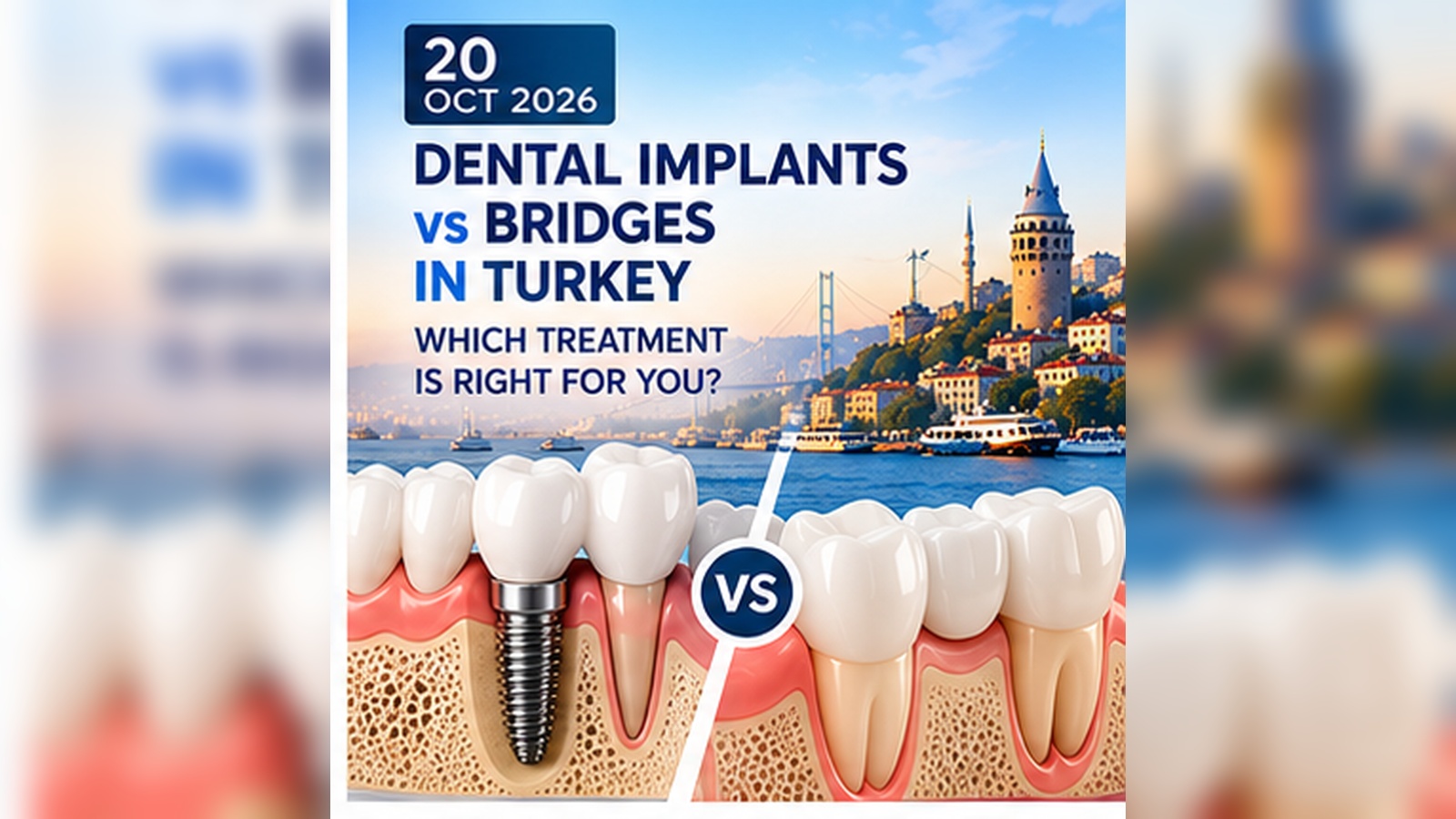 Dental implants versus bridges in Turkey