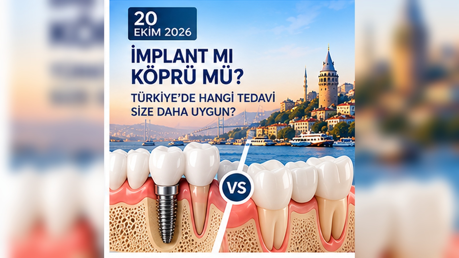 İmplant mı Köprü mü? Eksik Dişte Hangi Tedavi Size Daha Uygun?