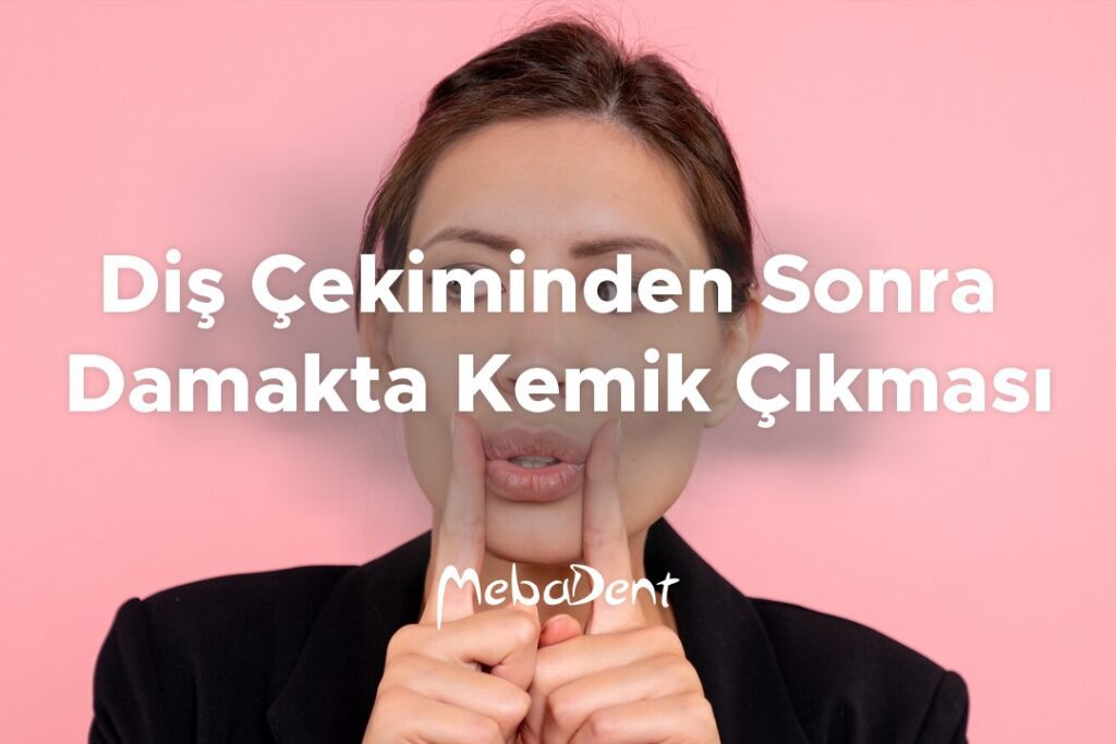 Diş Çekiminden Sonra Damakta Kemik Çıkması