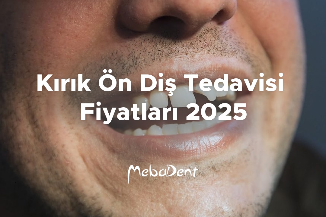Kırık Ön Diş Tedavisi Fiyatları 2025