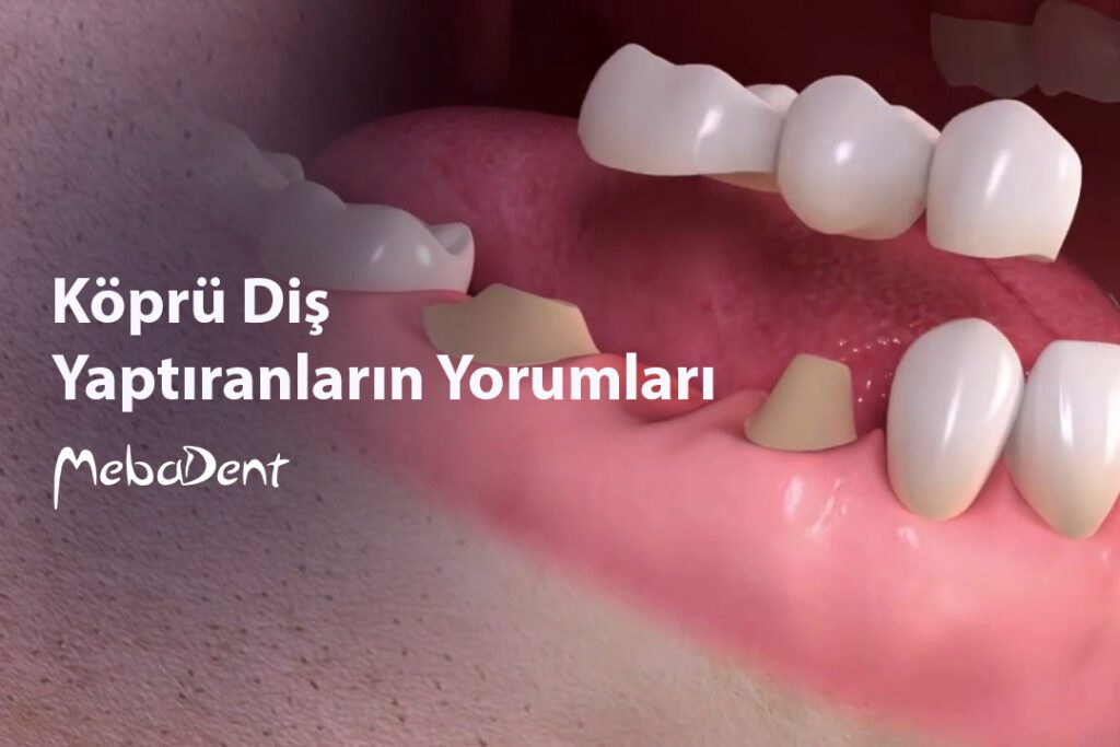 Köprü Diş Yaptıranların Yorumları