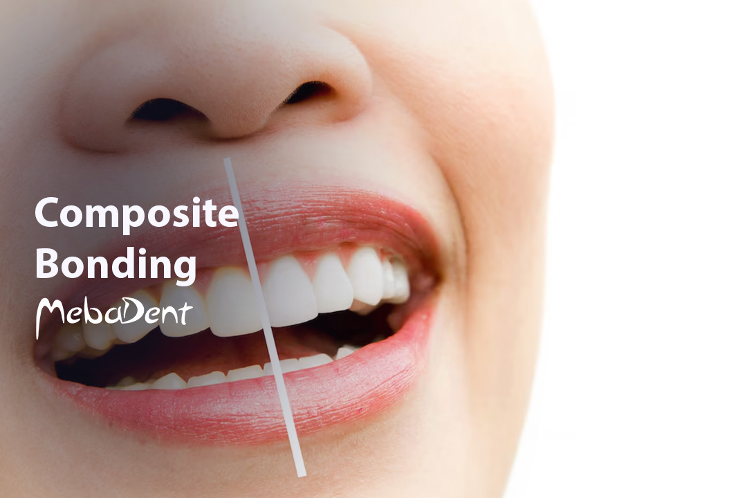 Composite Bonding