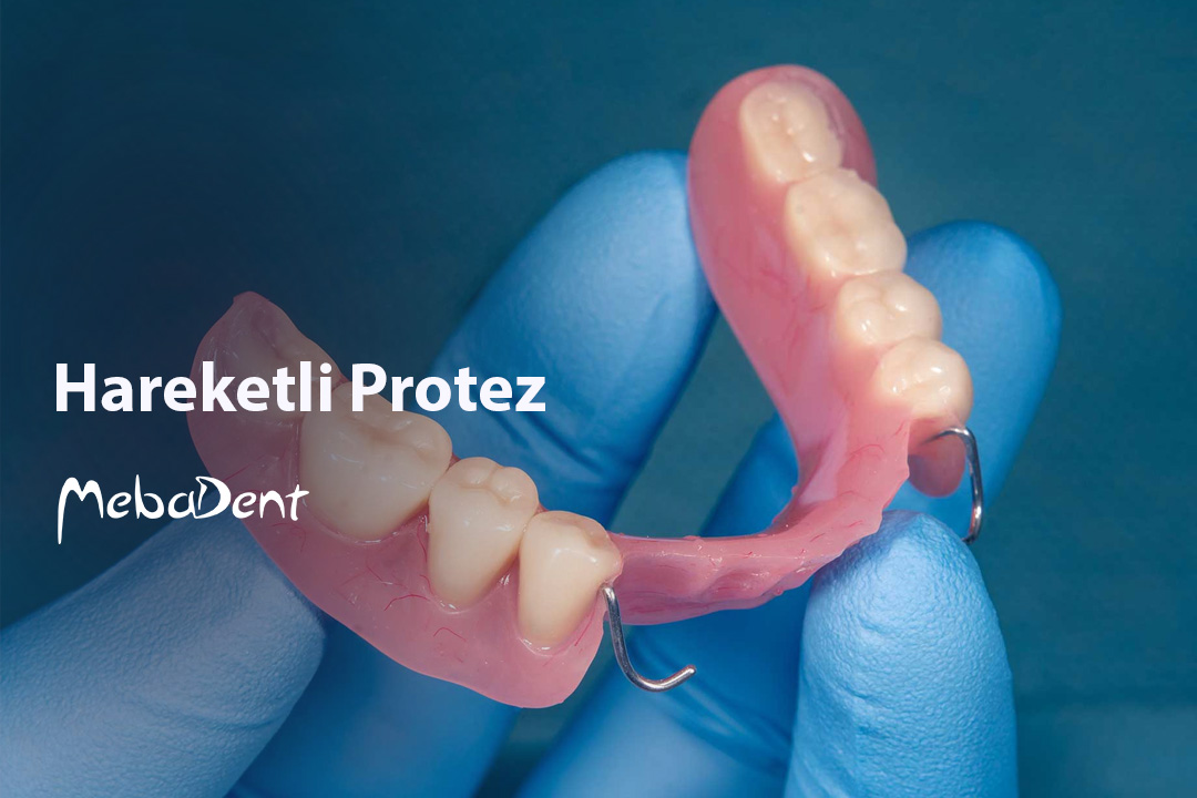 Hareketli Protez