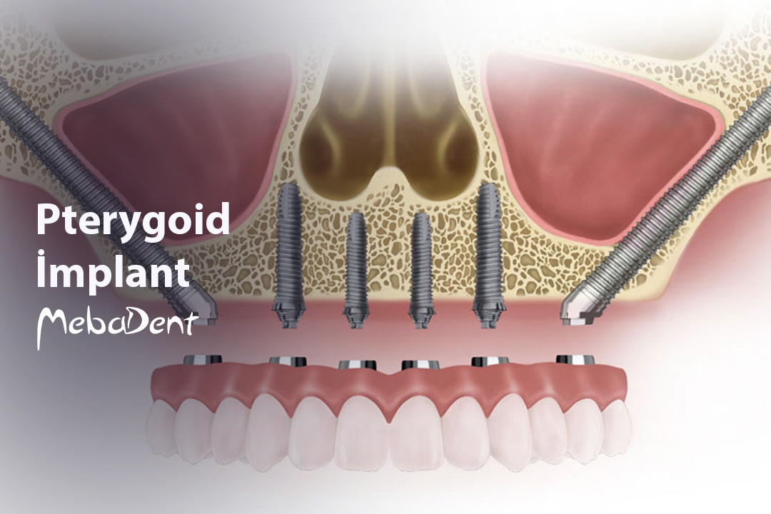 Pterygoid İmplant