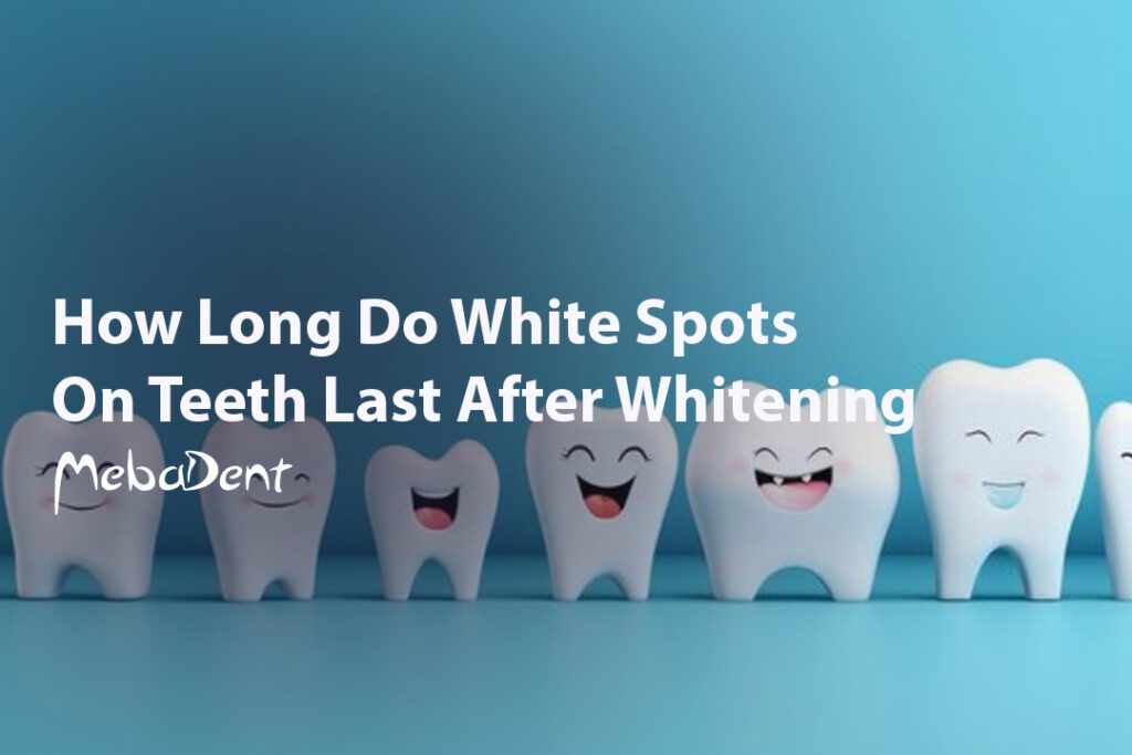 How-Long-Do-White-Spots-On-Teeth-Last-After-Whitening