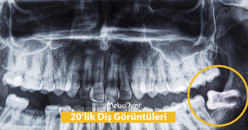 20'lik Diş Görüntüleri