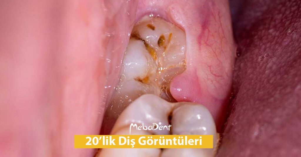 20'lik Diş Görüntüleri