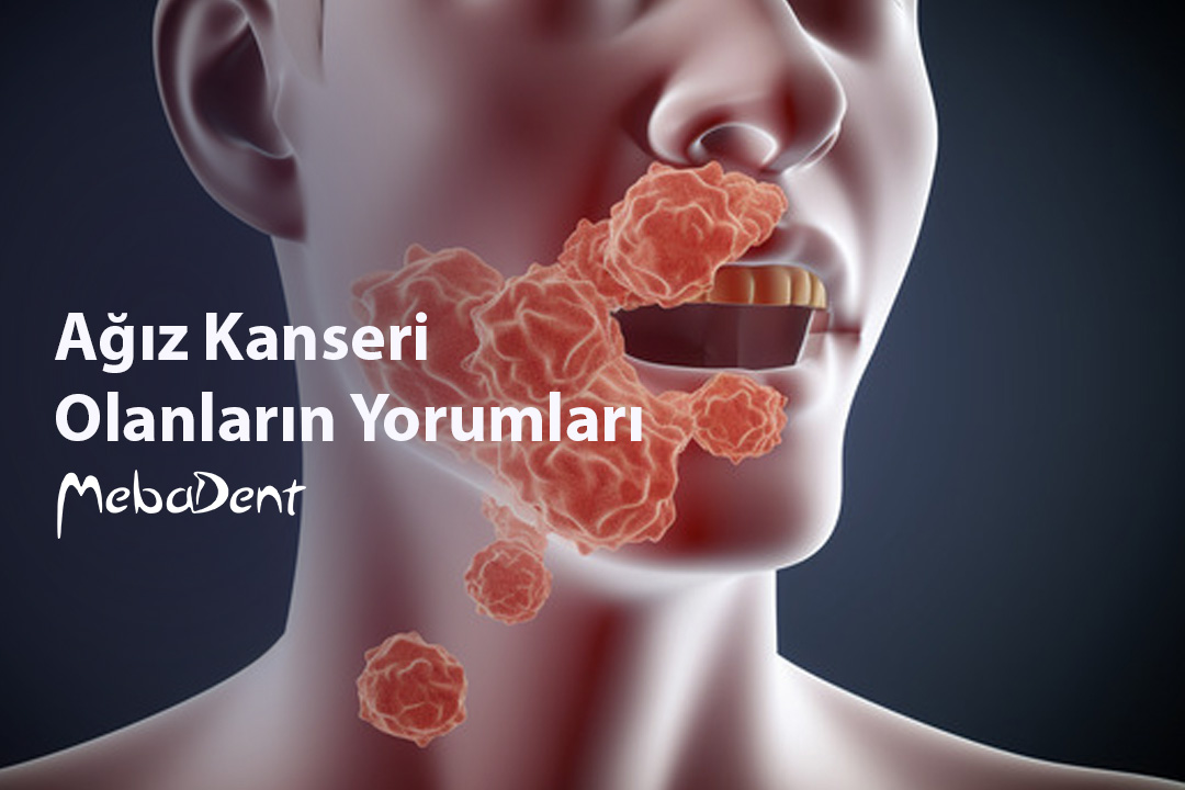 Ağız Kanseri Olanların Yorumları