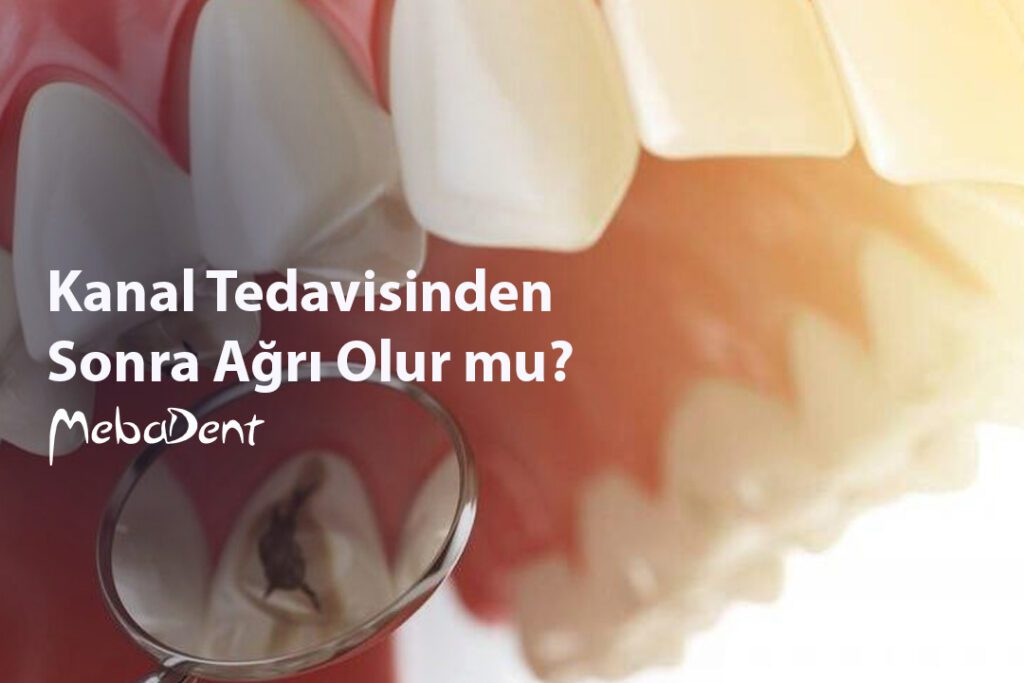 Kanal Tedavisinden Sonra Ağrı Olur mu?