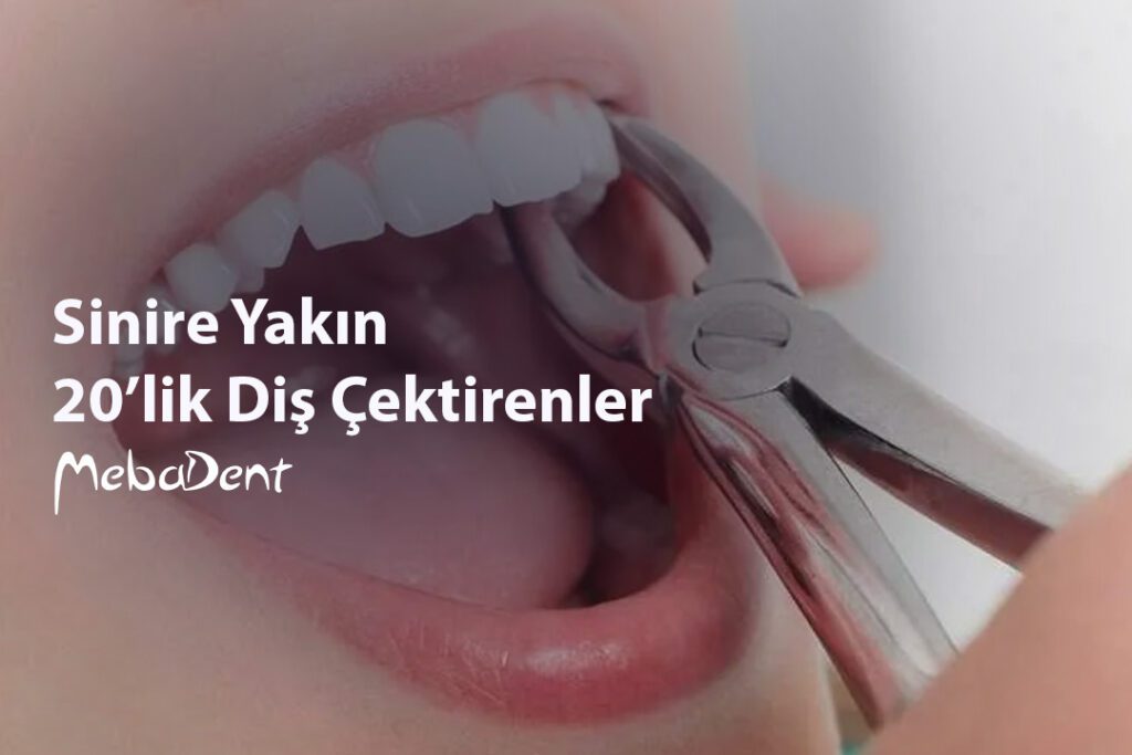 Sinire Yakın 20’lik Diş Çektirenler