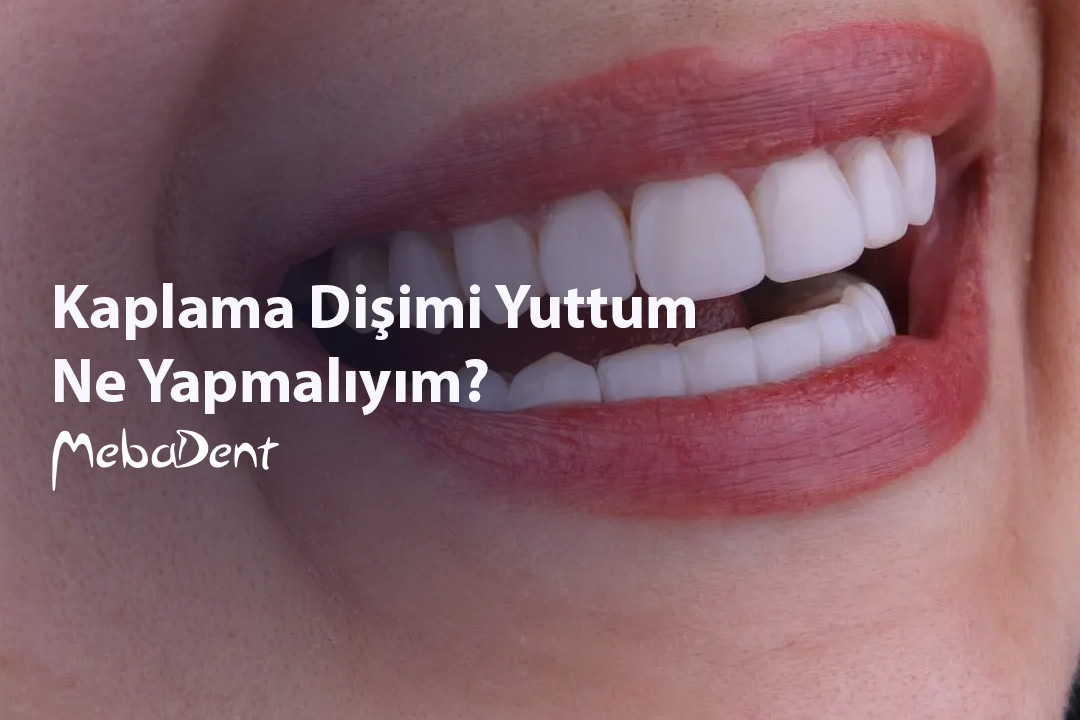 Kaplama Dişimi Yuttum, Ne Yapmalıyım?