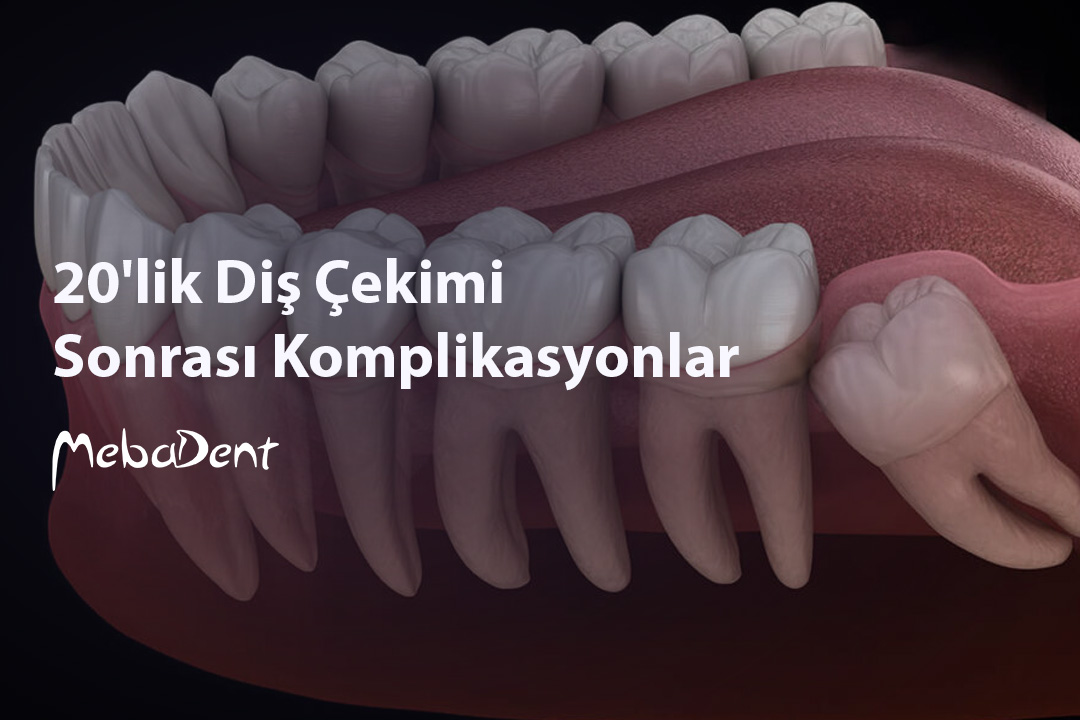 20'lik Diş Çekimi Sonrası Komplikasyonlar