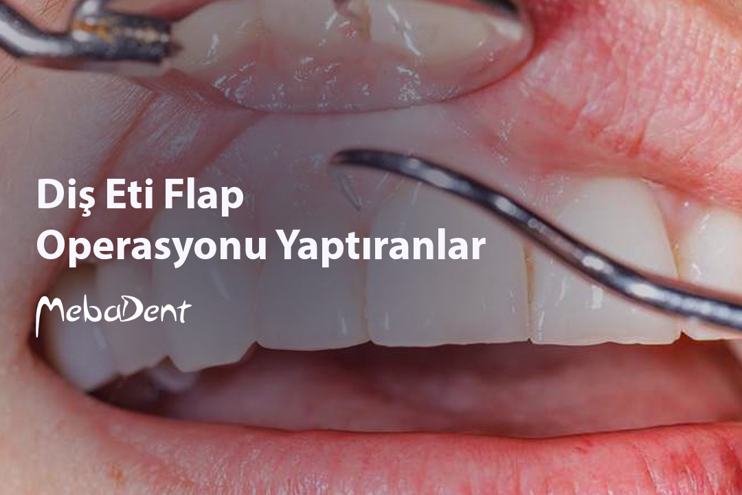 Diş Eti Flap Operasyonu Yaptıranlar