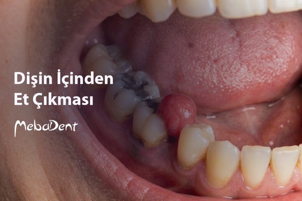 Dişin İçinden Et Çıkması