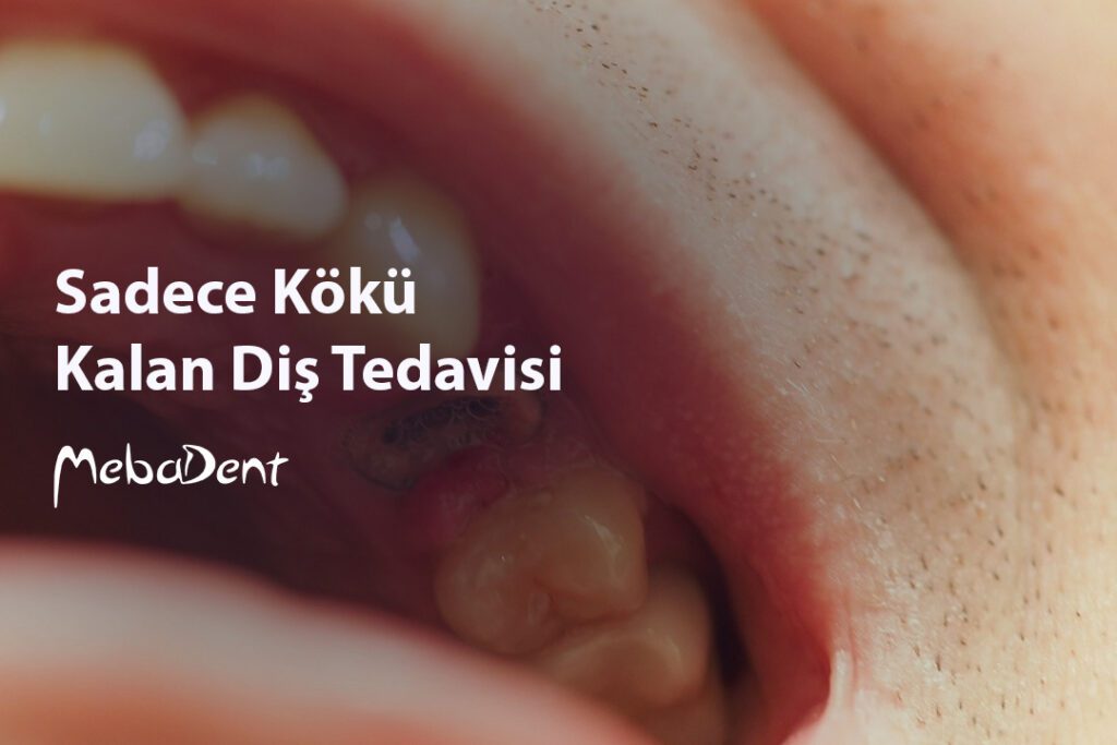 Sadece Kökü Kalan Diş Tedavisi