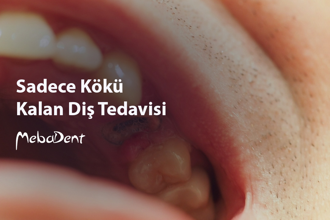 Sadece Kökü Kalan Diş Tedavisi