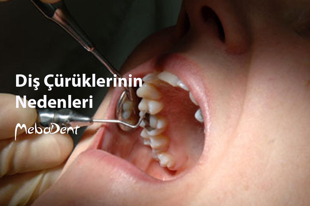 Çürük Diş Ağrısına Ne İyi Gelir?