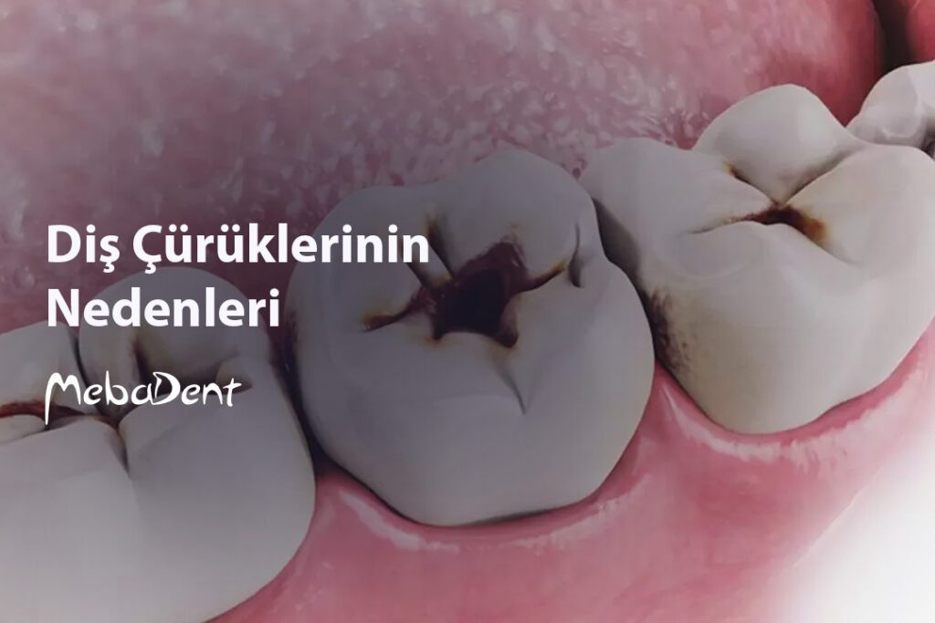 Diş Çürüklerinin Nedenleri
