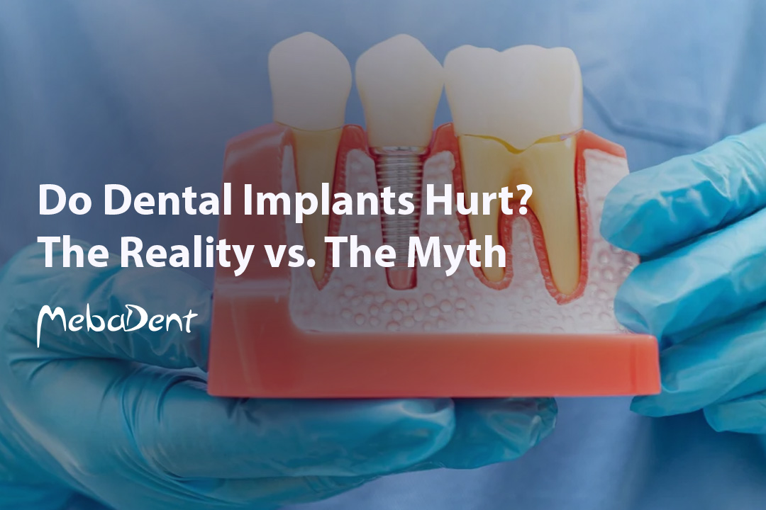 Do Dental Implants Hurt? The Reality vs. The Myth