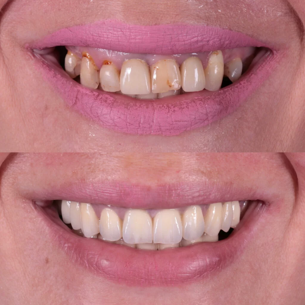 Zirkonyum Diş öncesi sonrası