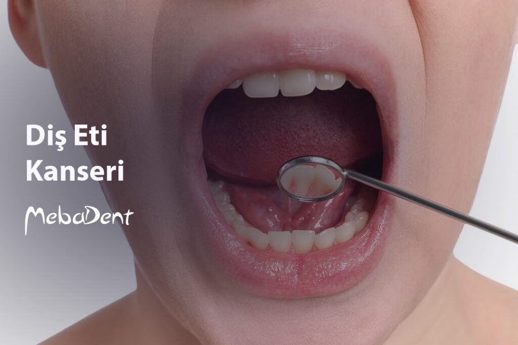 Diş Eti Kanseri