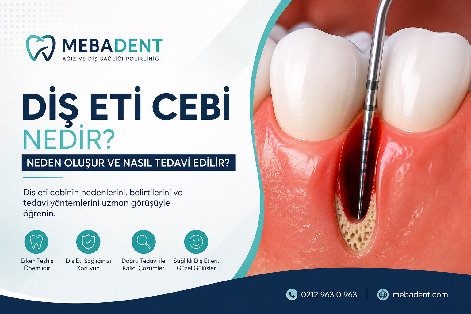 Diş Eti Cebi Nedir? Neden Oluşur ve Nasıl Tedavi Edilir?