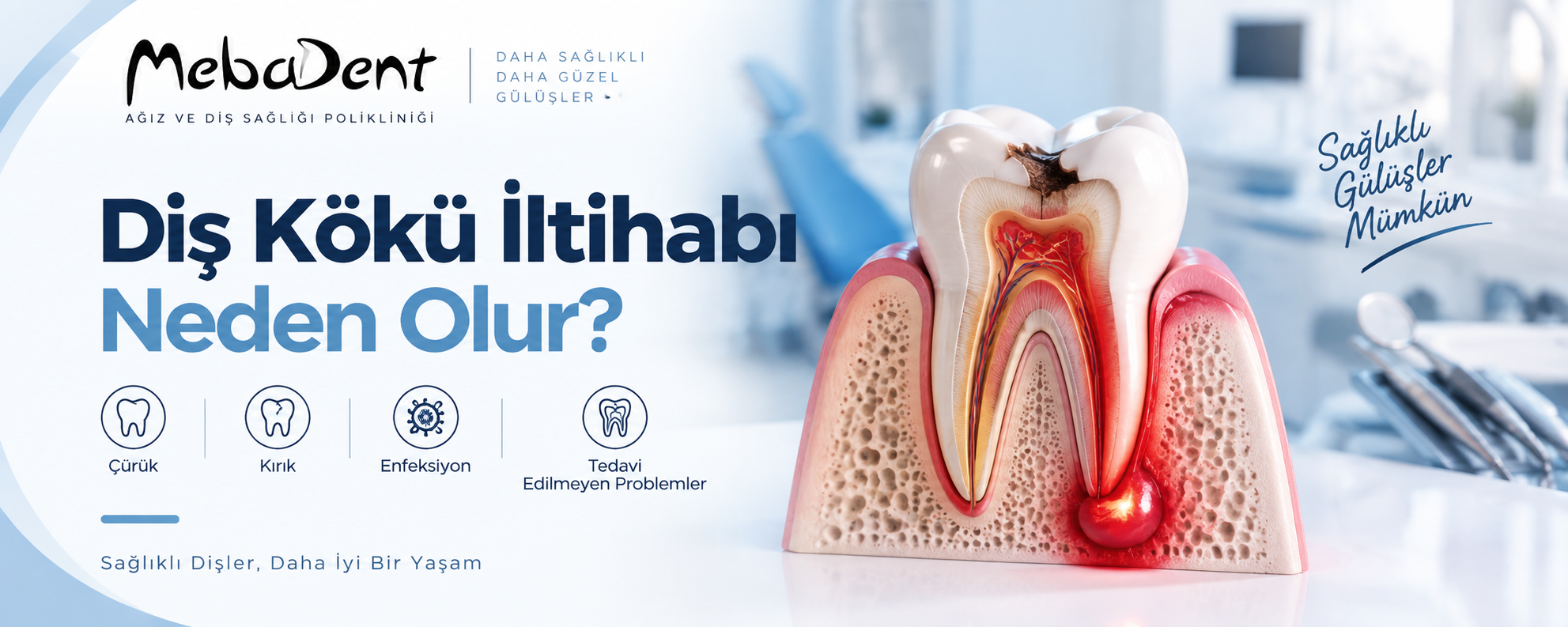 Diş Kökü İltihabı Neden Olur?